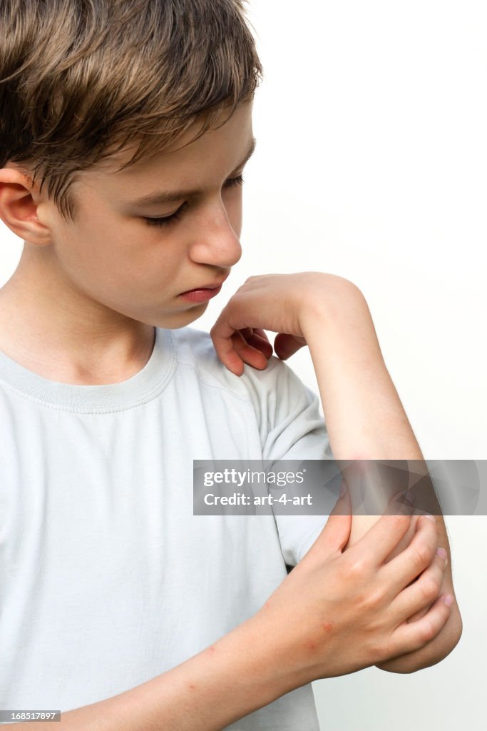 Boy looking at mosquito bite