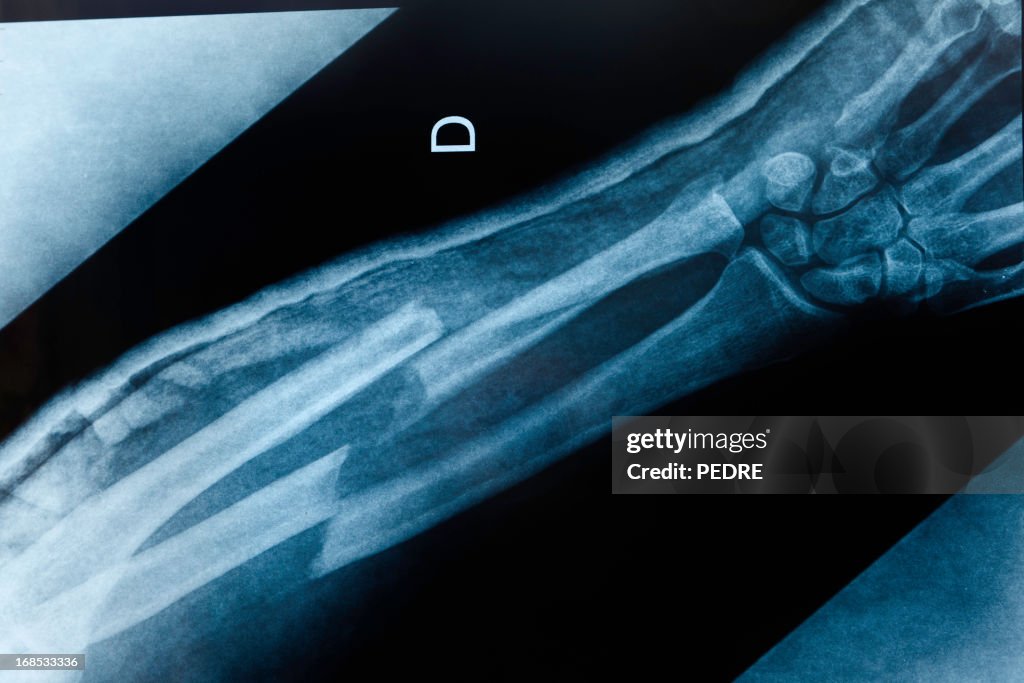 Gebrochener arm x-ray