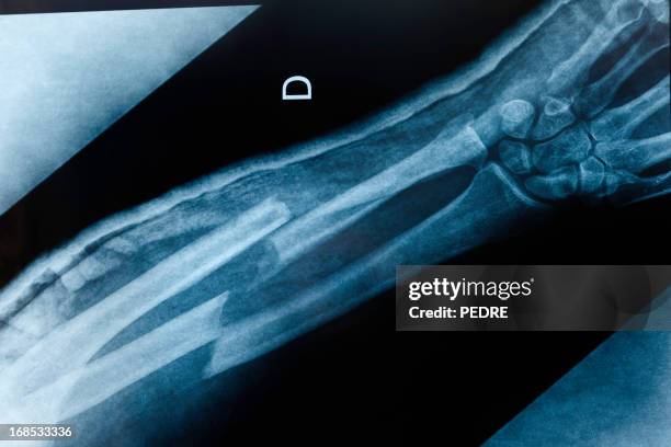 gebrochener arm x-ray - knochenbruch stock-fotos und bilder