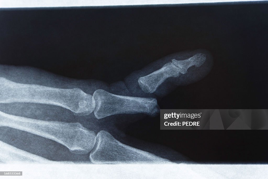 X-Ray gebrochenen Finger