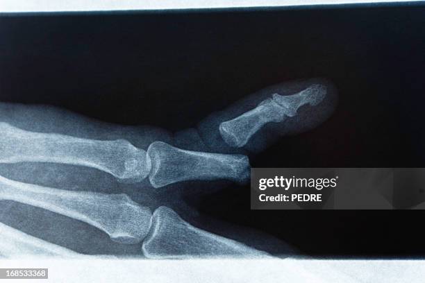 x-ray partido dedo - break into small pieces imagens e fotografias de stock