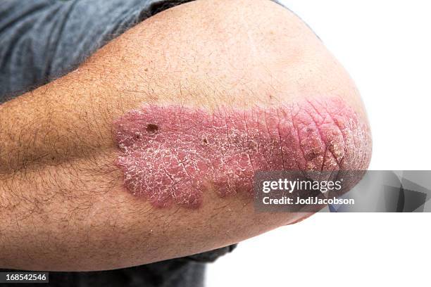 psoriasis en mans codo de mediana edad - psoriasis fotografías e imágenes de stock