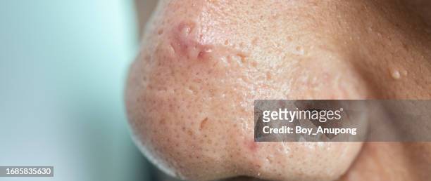 cropped shot of hair follicles and pores on asian men's nose. - cyst fotografías e imágenes de stock