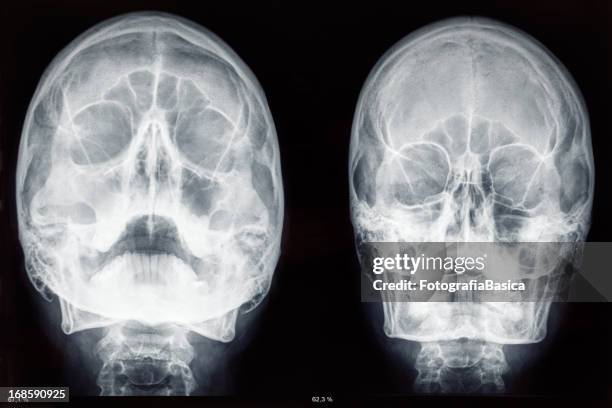 two skulls x-rays - sinusitis stock pictures, royalty-free photos & images