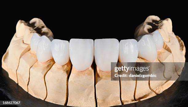 chapas dental - odontología cosmética fotografías e imágenes de stock
