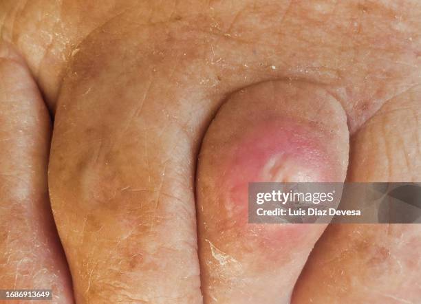 warts on the toes - plantaire wrat stockfoto's en -beelden