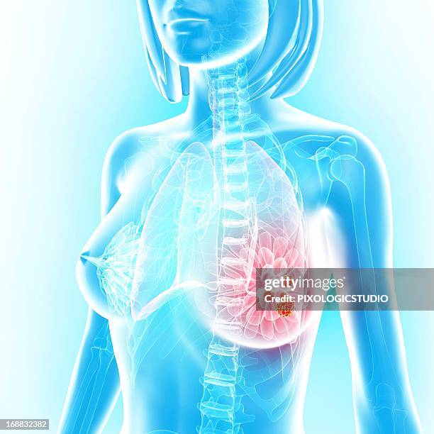 breast cancer, artwork - metastasis stock illustrations