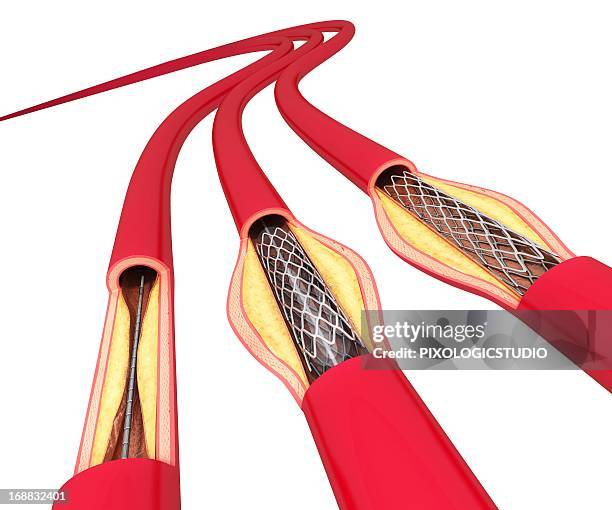 Stent Dissection Ilustraciones, imágenes clip art, dibujos animados e iconos de stock de ...