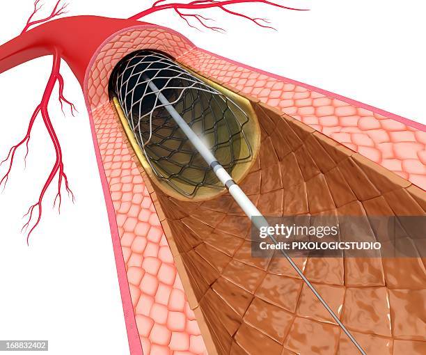 stockillustraties, clipart, cartoons en iconen met angioplasty, artwork - menselijke slagader