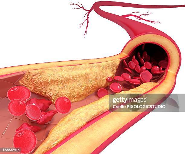 atherosclerosis, artwork - atheroma stock-grafiken, -clipart, -cartoons und -symbole
