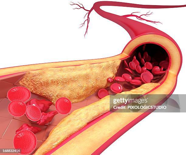 atherosclerosis, artwork - arterien stock-grafiken, -clipart, -cartoons und -symbole