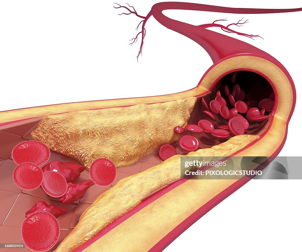 Atherosclerosis, artwork