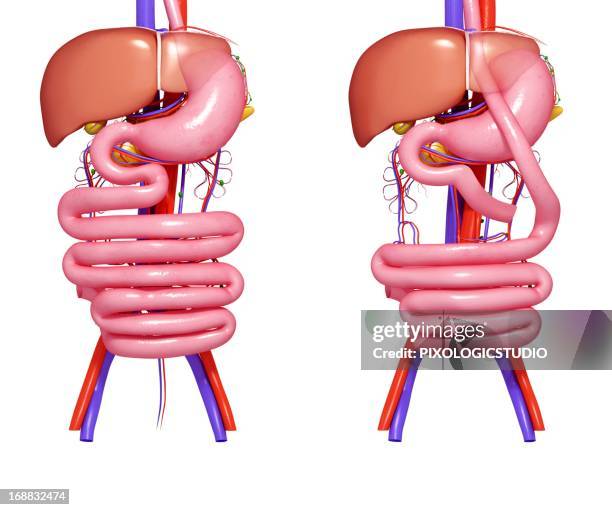 gastric bypass, artwork - bariatrics stock illustrations