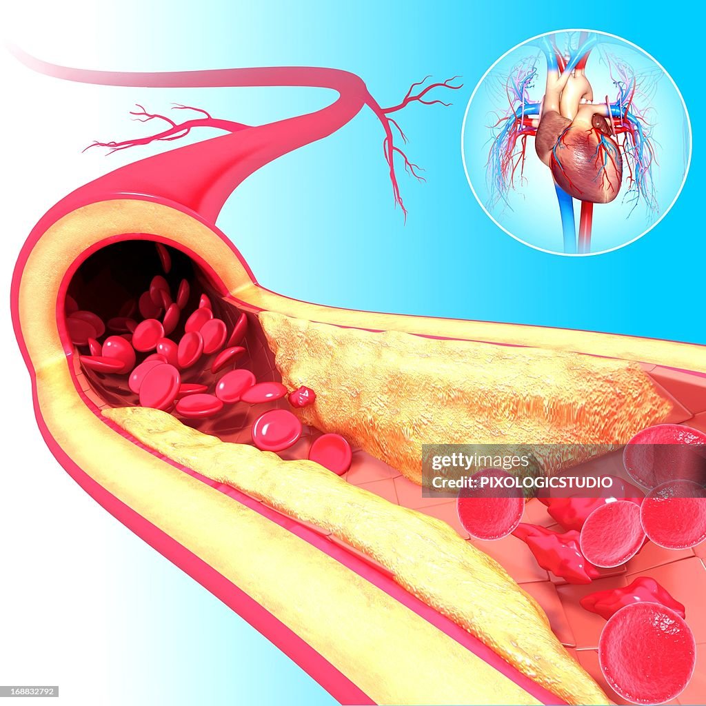 Atherosclerosis, artwork
