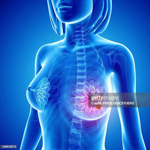 breast cancer, artwork - metastasis stock illustrations