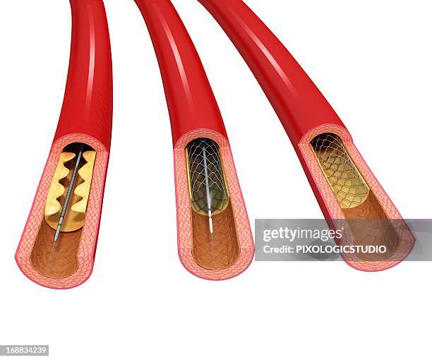 ilustrações de stock, clip art, desenhos animados e ícones de angioplasty, artwork - cateter