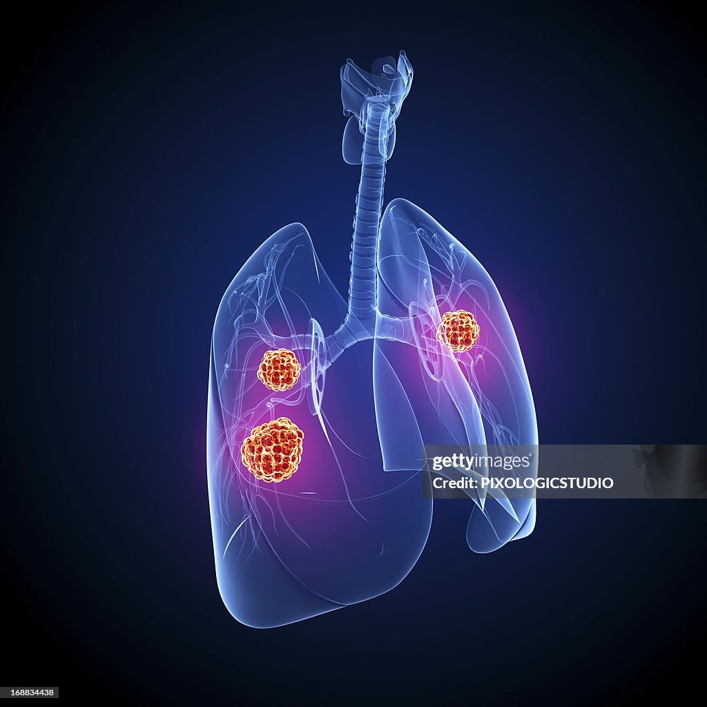 Lung cancer, artwork