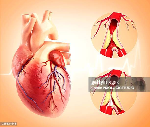 atherosclerosis, artwork - atherosklerose stock-grafiken, -clipart, -cartoons und -symbole
