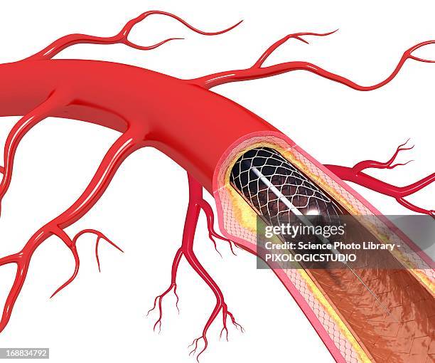 angioplasty, artwork - stent stock-grafiken, -clipart, -cartoons und -symbole