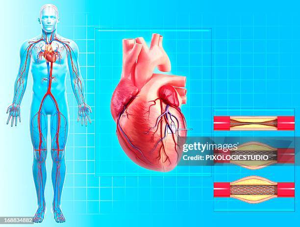 ilustrações de stock, clip art, desenhos animados e ícones de angioplasty, artwork - cateter