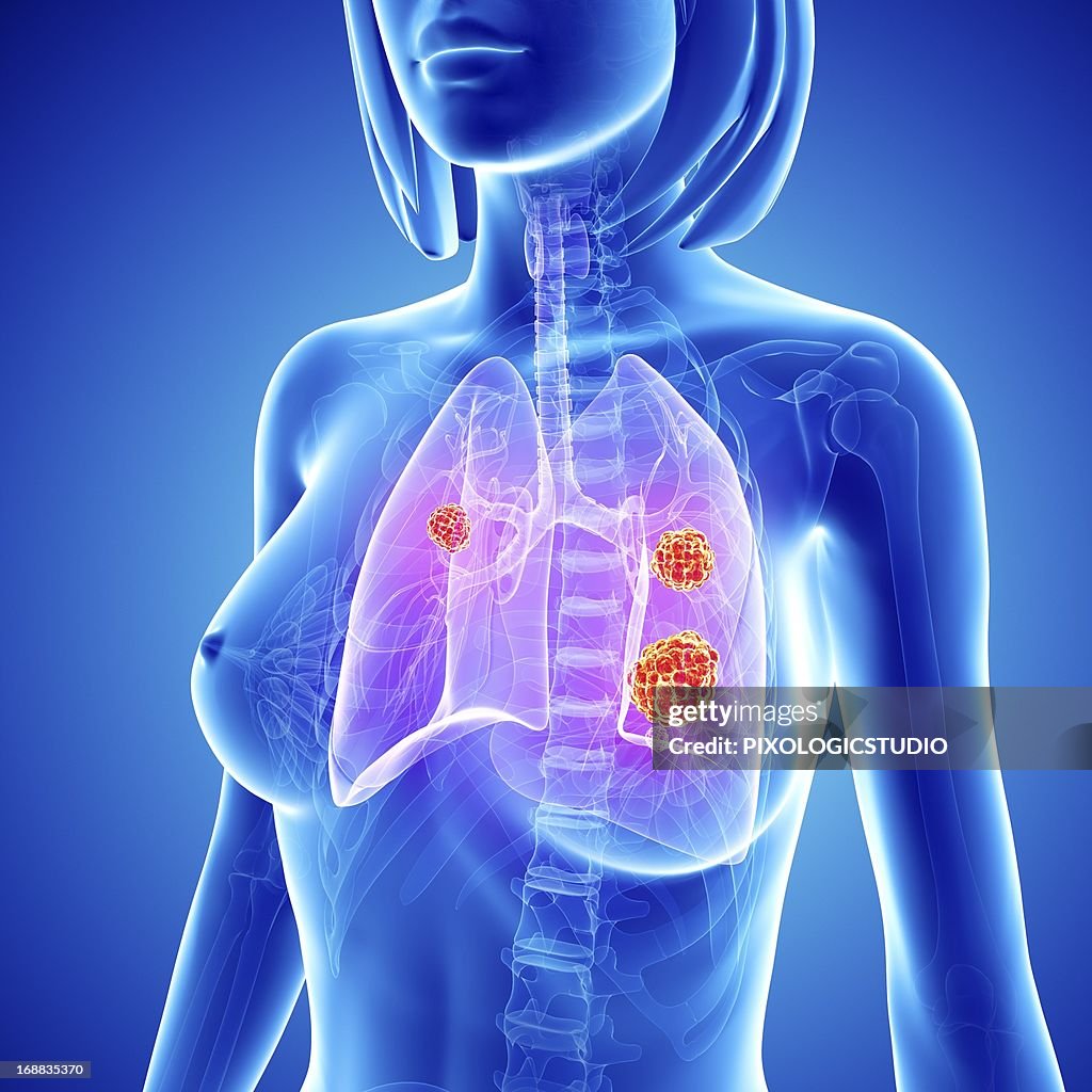 Female lung cancer, artwork