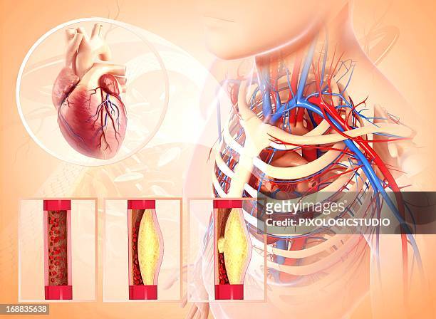 atherosclerosis, artwork - carotid artery stock illustrations