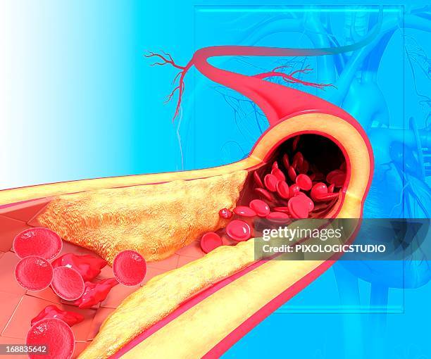 stockillustraties, clipart, cartoons en iconen met atherosclerosis, artwork - menselijke slagader