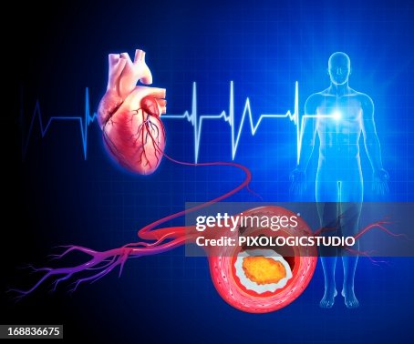 Atherosclerosis, artwork Atherosclerosis, artwork