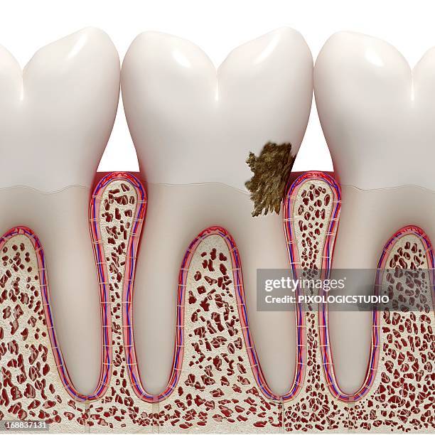 ilustraciones, imágenes clip art, dibujos animados e iconos de stock de dental plaque, artwork - plaque bacteria