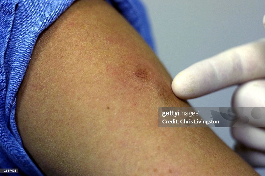 Smallpox Vaccination Study in Florida
