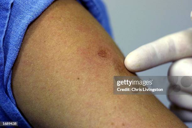 Dr. Ronald Brown points out a patient's scars from previous smallpox vaccinations December 16, 2002 at Mid-Florida Biologicals in Altamonte Springs,...