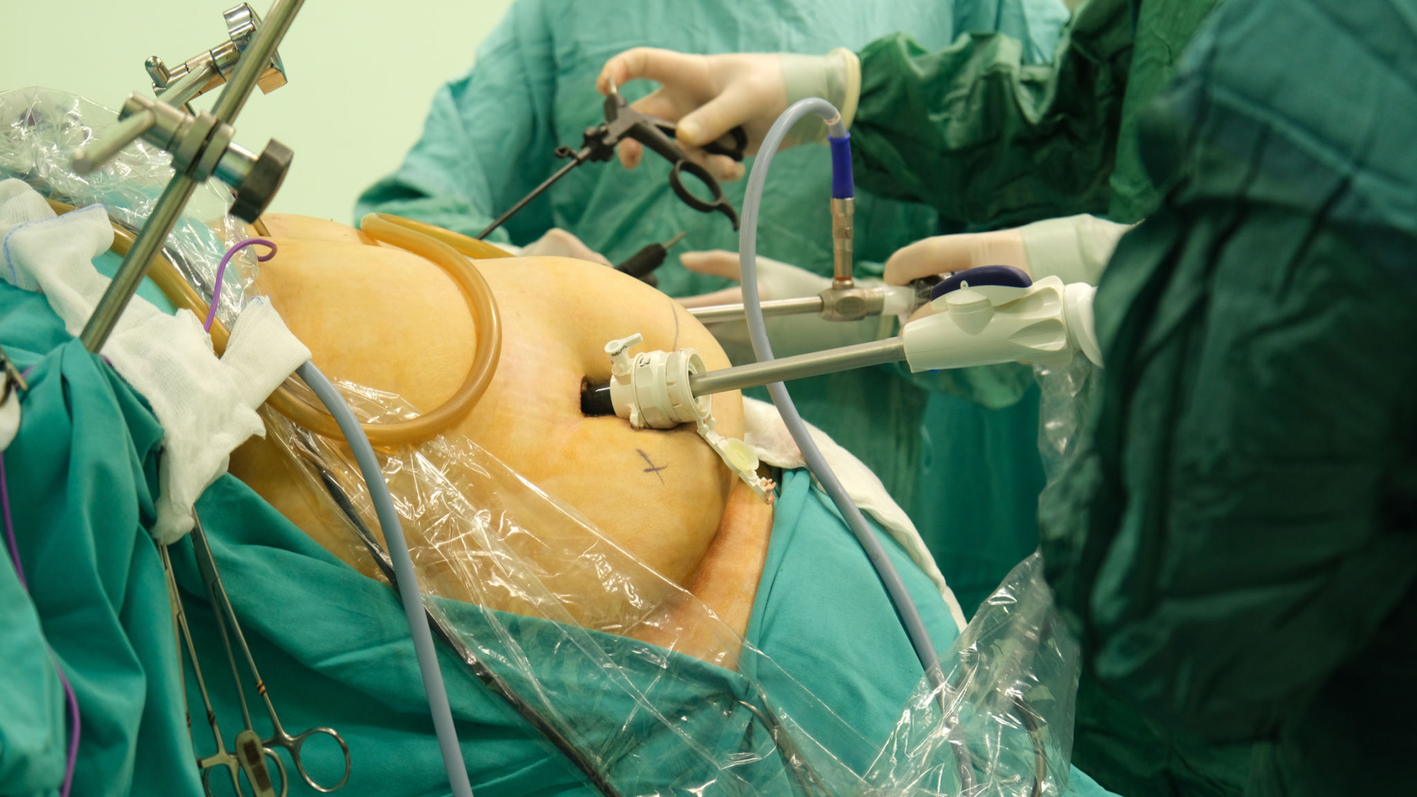 cirurgia bariátrica