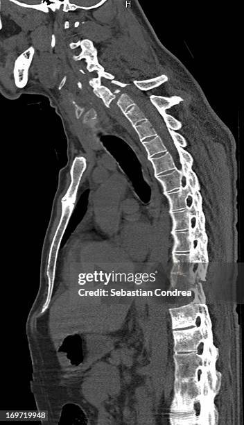 ankylosing spondylitis - espondilitis anquilosante fotografías e imágenes de stock