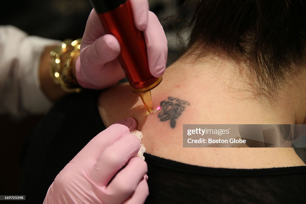 Nondoctors Enter World Of Tattoo Removal