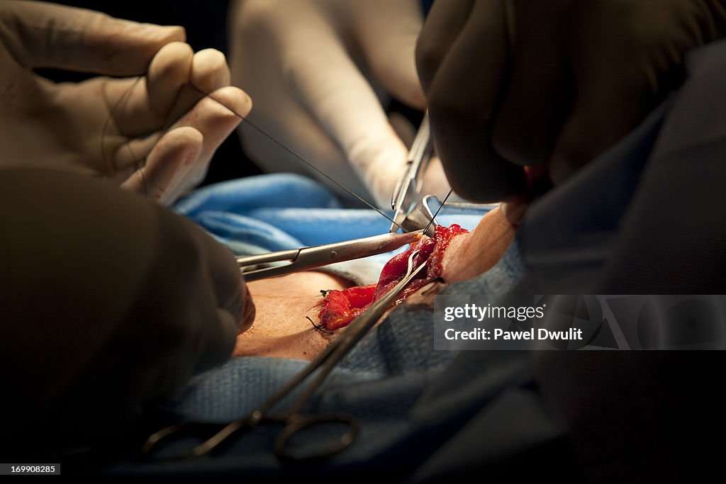 Thyroid Surgery