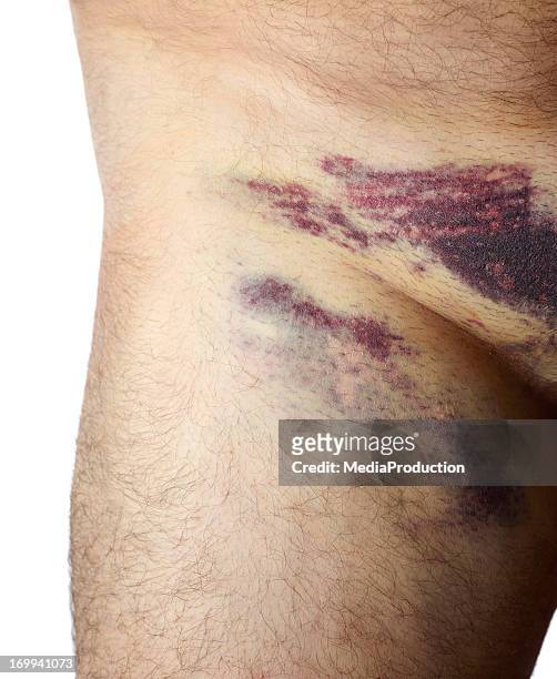 groin bruising after angiogram - male crotch stock pictures, royalty-free photos & images