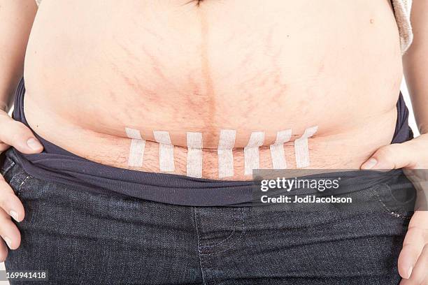 caesarean section with steri strips - caesarean section stock pictures, royalty-free photos & images