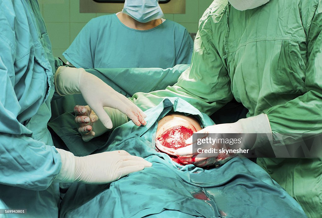 Baby being born via Caesarean Section.