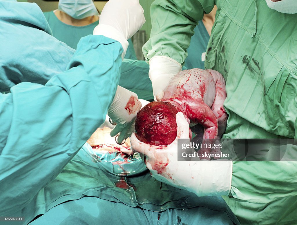 Baby being born via real Caesarean Section.