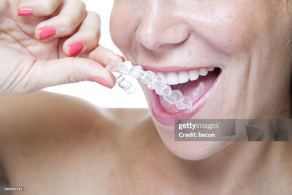 Clear Braces