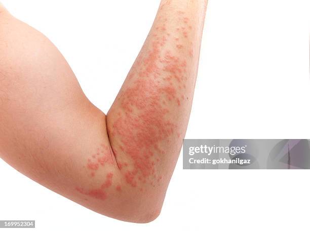 skin allergy - bumpy stockfoto's en -beelden