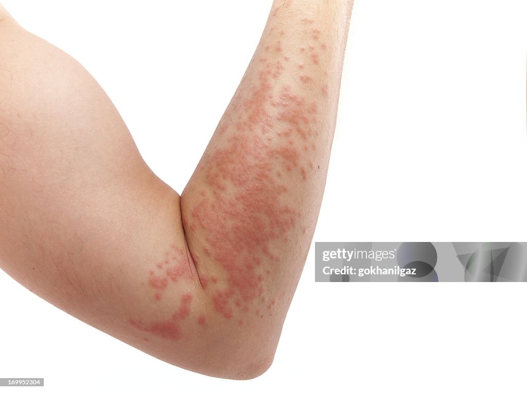 Skin allergy