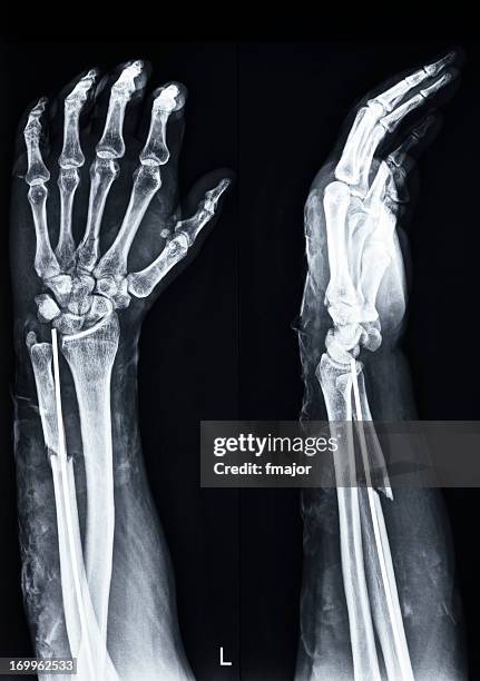 fracture of ulna(arm) and third metacarp(hand) - artificial arm stock pictures, royalty-free photos & images