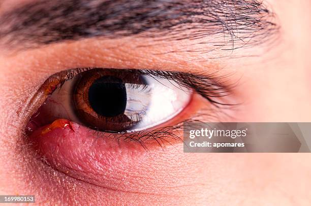 stye-infección ocular - swollen fotografías e imágenes de stock