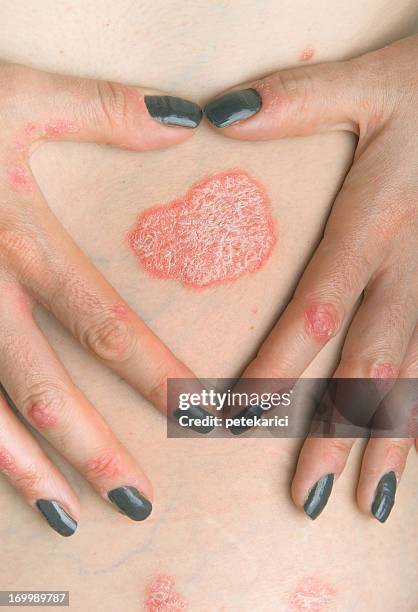 psoriasis - psoriasis stock pictures, royalty-free photos & images