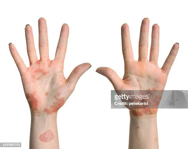 psoriasis hand - psoriasis stock pictures, royalty-free photos & images
