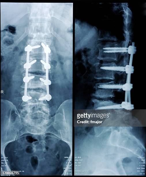 spondylolisthesis - human vertebra 個照片及圖片檔
