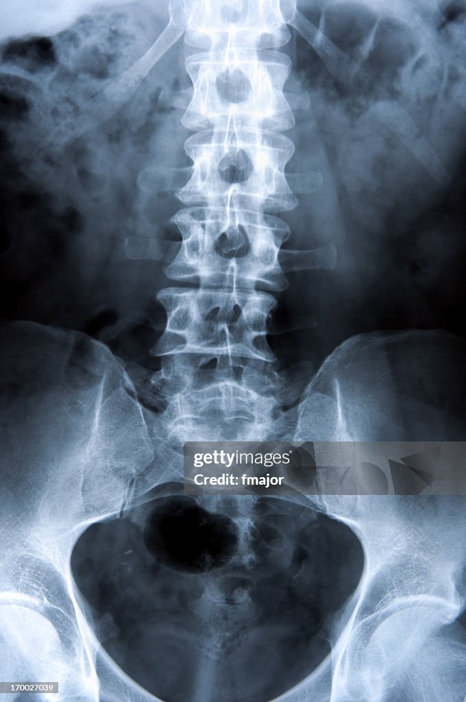 Spondylolisthesis