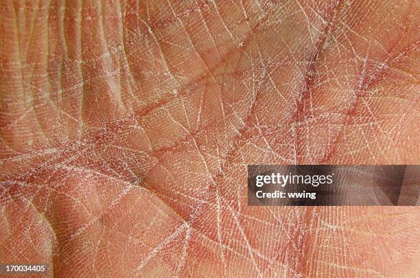 sequedad de la piel, como se muestra en la palma de la mano agrietados. - dried fotografías e imágenes de stock