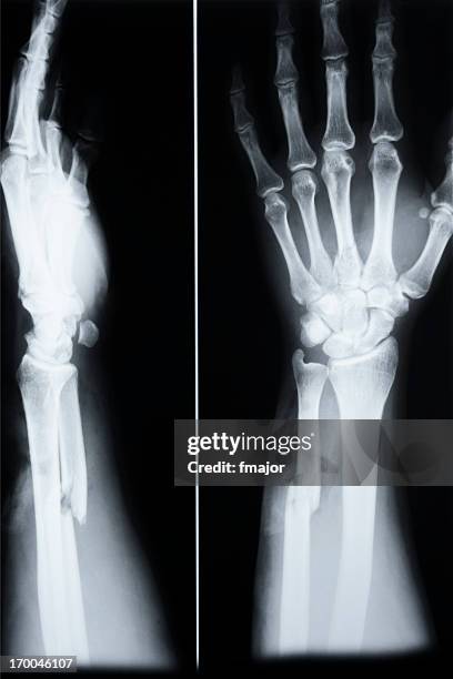 骨折の尺骨(arm)と 3 metacarp (手動) - broken finger ストックフォトと画像